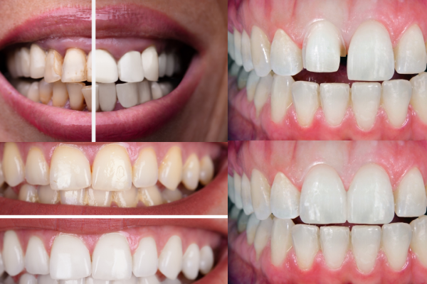 mexican dentist near me Cosmetic porcelain veneers walk in dentist mear me