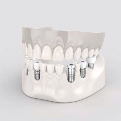 mexico dental implants