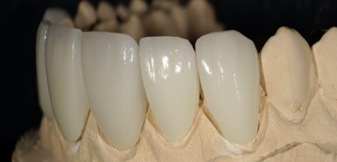 Porcelain Dental Veneers in Tijuana Before and After